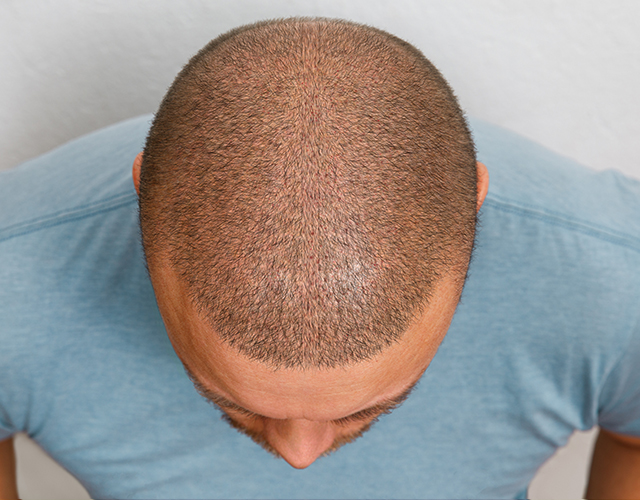 Hair Transplant Timeline: Recovery and What to Expect