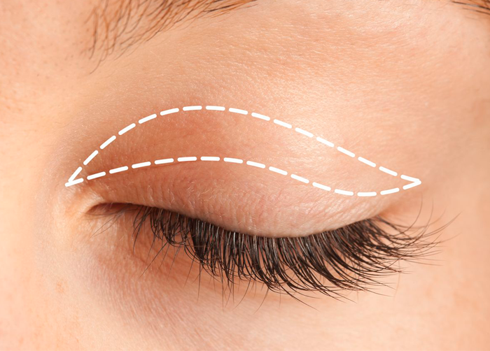 Blepharoplasty