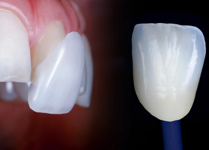 Laminate Veneers