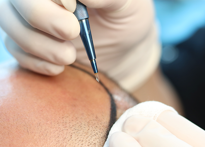 Sapphire FUE Hair Transplant