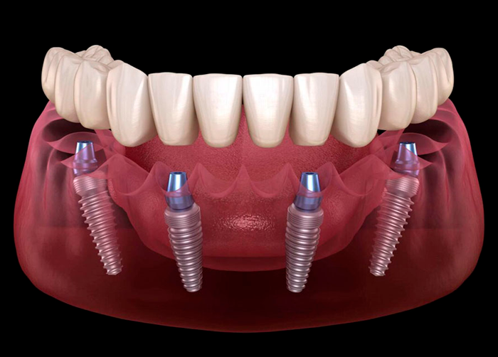 All-on-4 Treatment