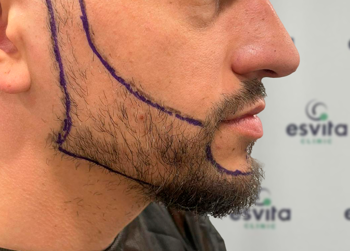 Beard Transplant