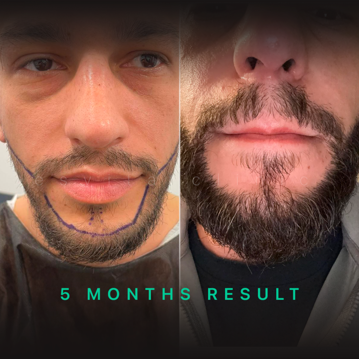 Пересадка бороды – До и После