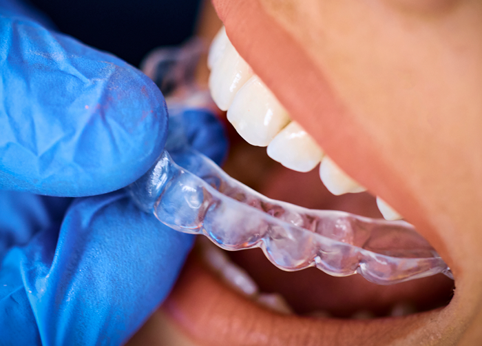 Clear Aligners