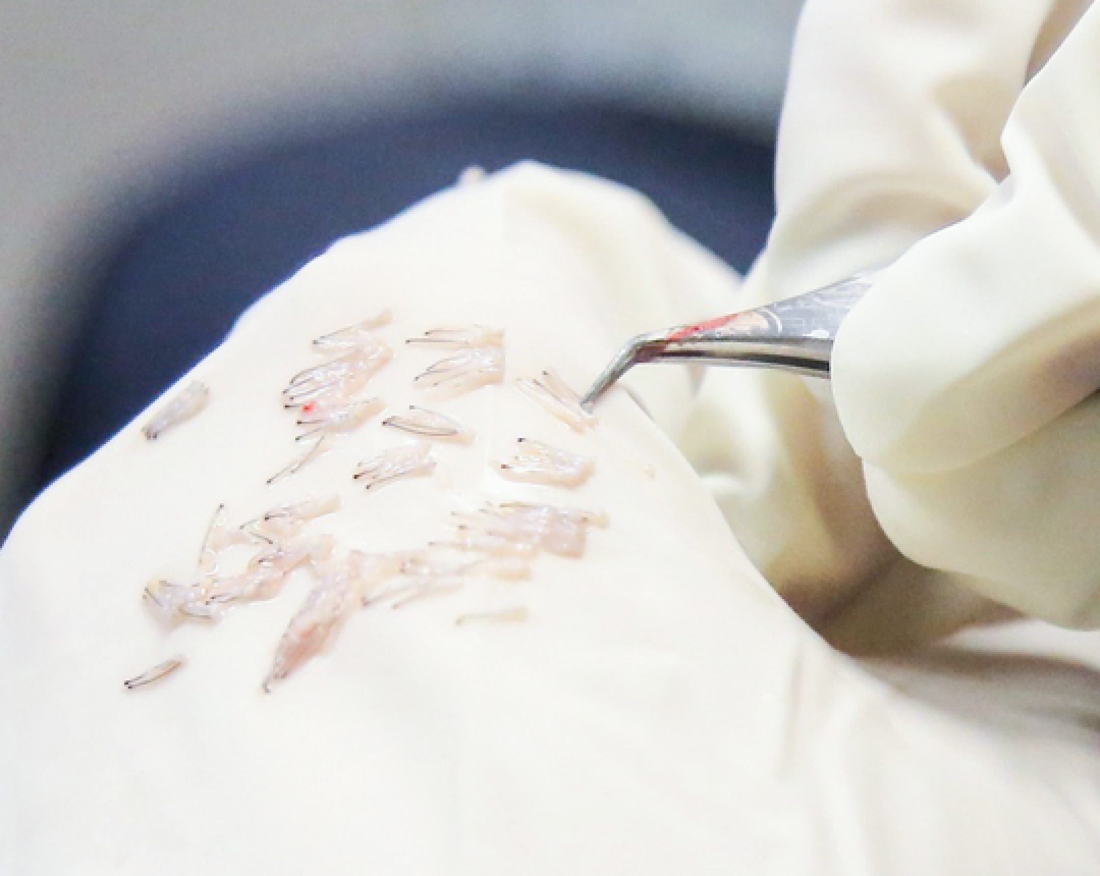 DHI Hair Transplant - Esvita Clinic