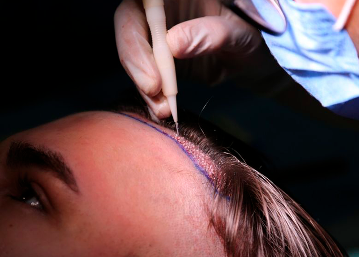 DHI Hair Transplant