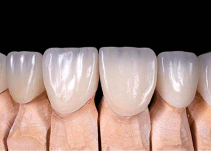 Emax Crowns