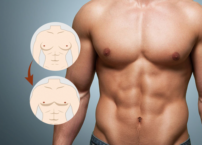 Gynecomastia