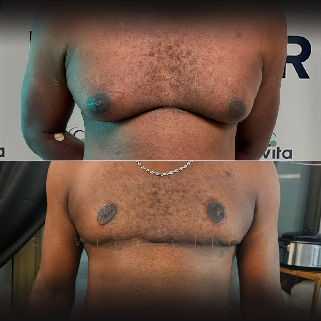 Гинекомастия — До и После