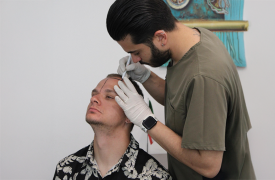 1/6 Joe ヘッド with Hair Implantation DHI Hair Transplant - Esvita Clinic