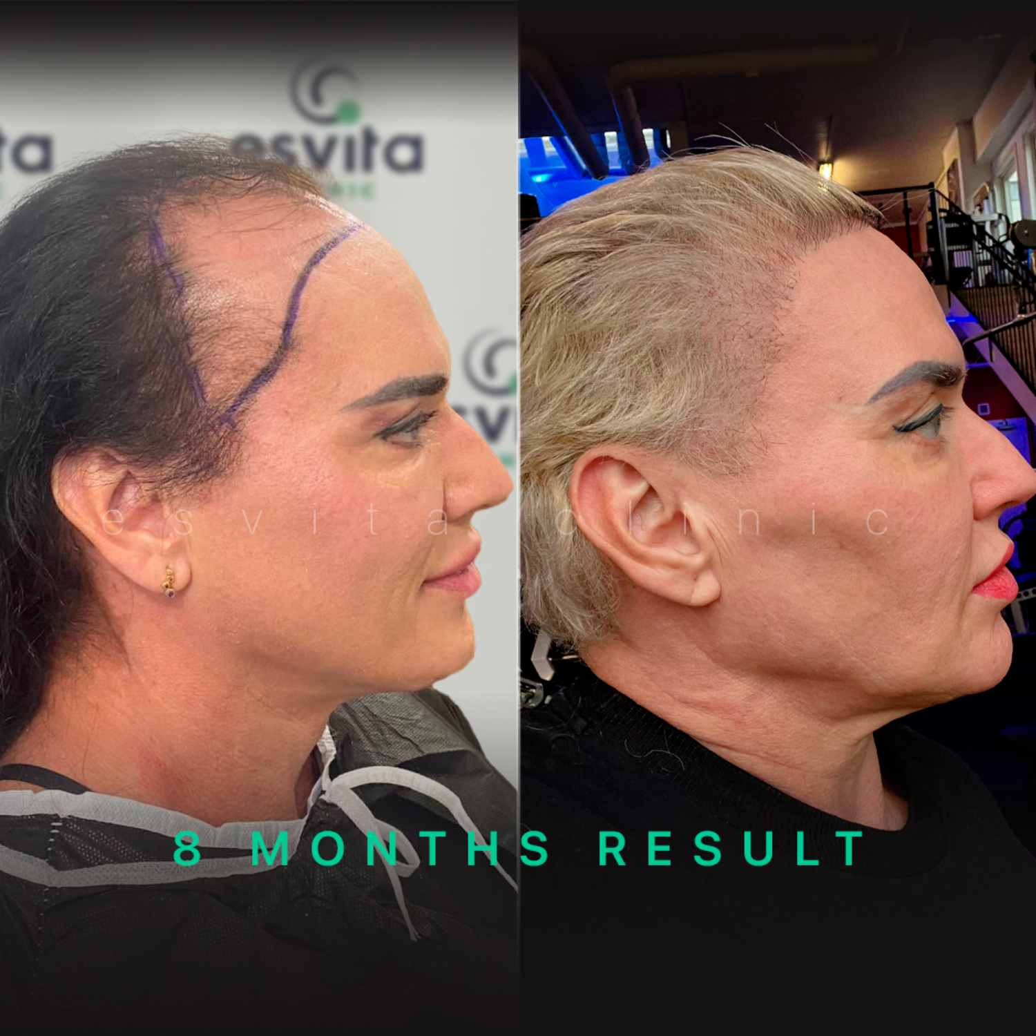 Пересадка волос женщинам — до и после