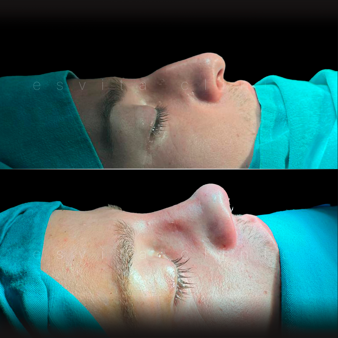 Rhinoplasty – Before & After