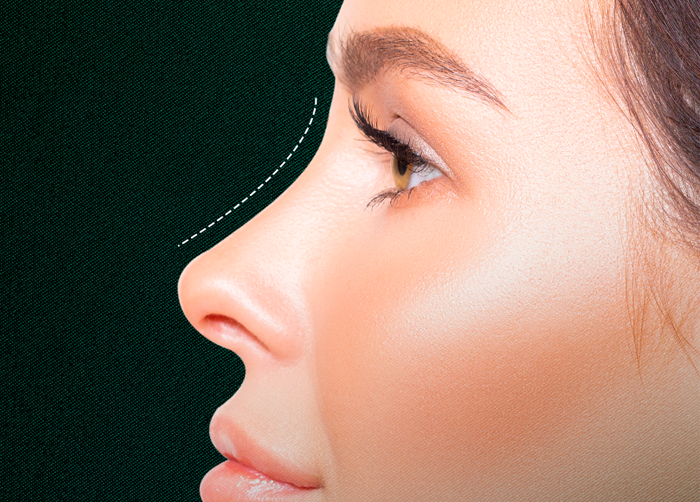 Rhinoplasty