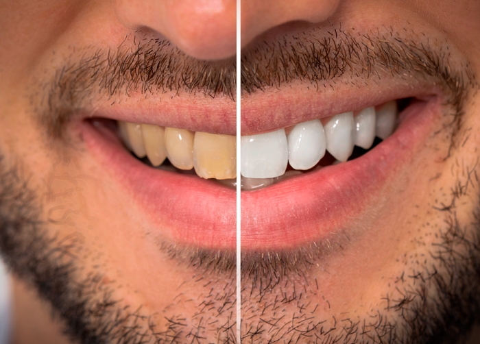 Teeth Whitening