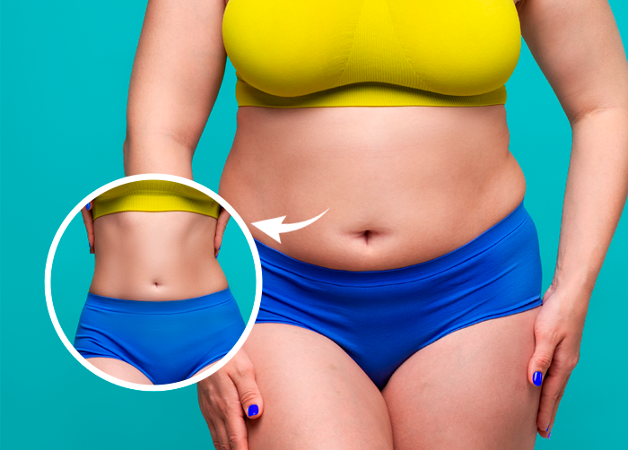 Tummy Tuck