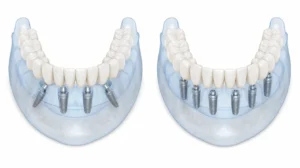 All-on-4 vs All-on-6 dental implants comparison