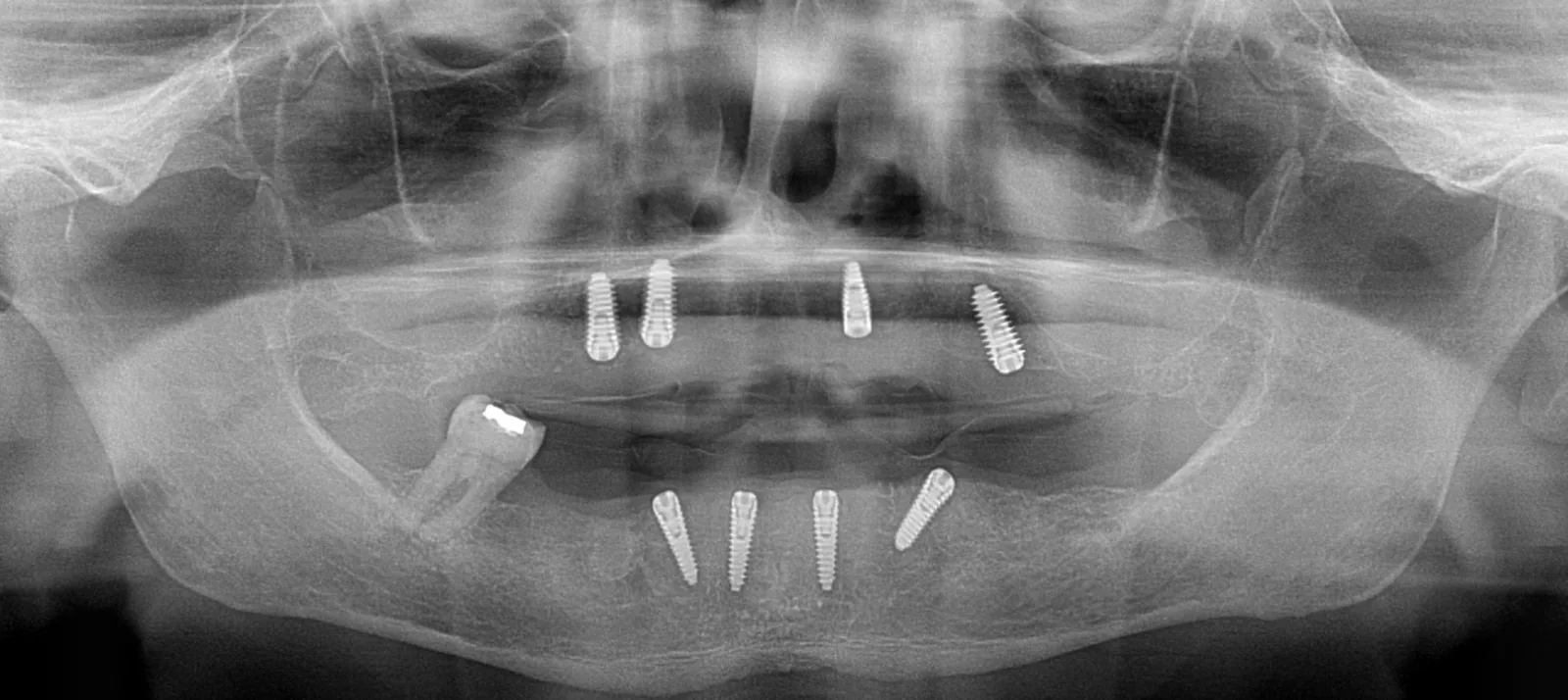 X-ray of an Esvita All-on-4 case