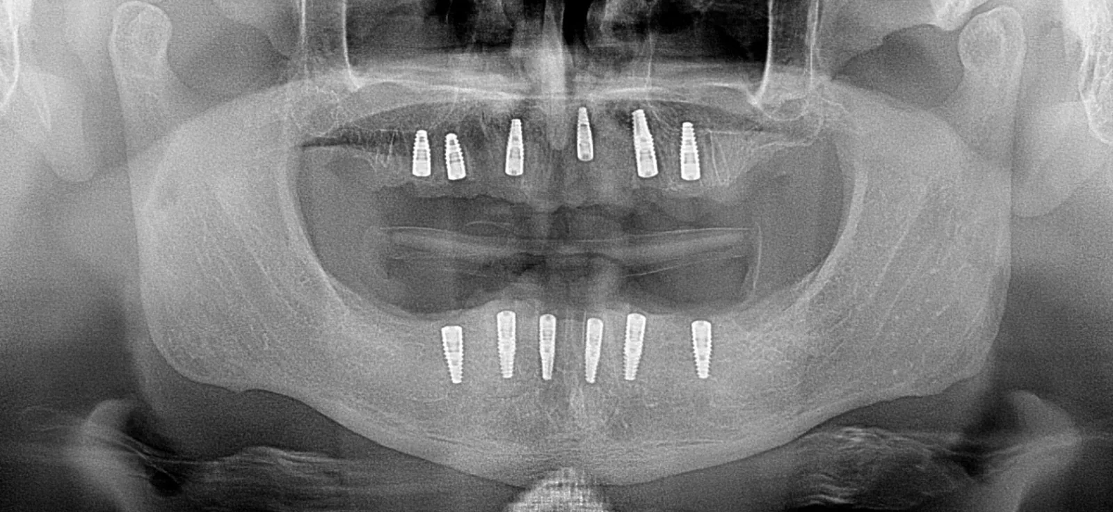X-ray of an Esvita All-on-6 case